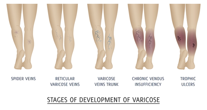 Varicose Veins